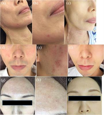 Case report: Effectiveness of pulsed dye laser in facial redness of atopic dermatitis: a report of three cases